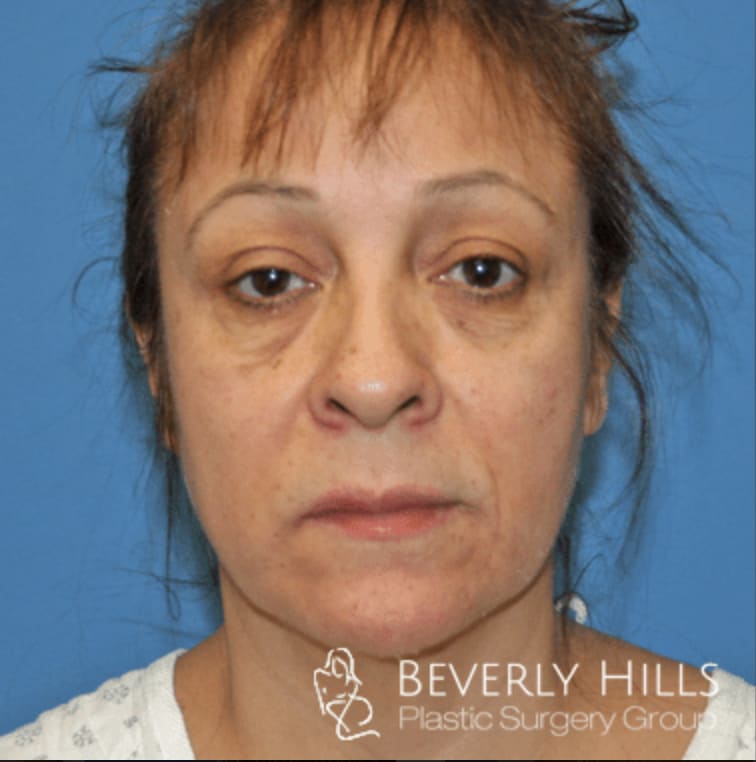 Facelift Before, Female 54 - 3326
