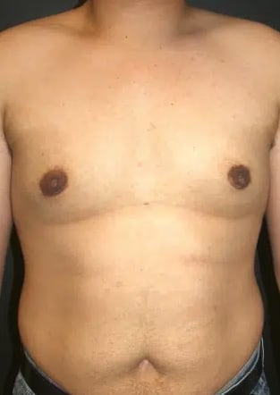 Male Breast Reduction (Gynecomastia Surgery) After, Male 38 - 3417