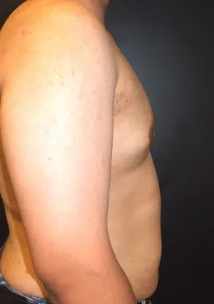Male Breast Reduction (Gynecomastia Surgery) After, Male 38 - 3419