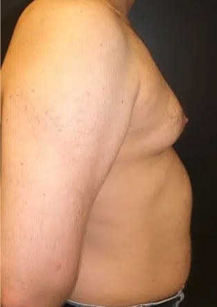 Male Breast Reduction (Gynecomastia Surgery) Before, Male 32 - 3421