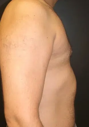 Male Breast Reduction (Gynecomastia Surgery) After, Male 32 - 3421