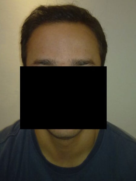 Hair Restoration After, Male 35 - 3457