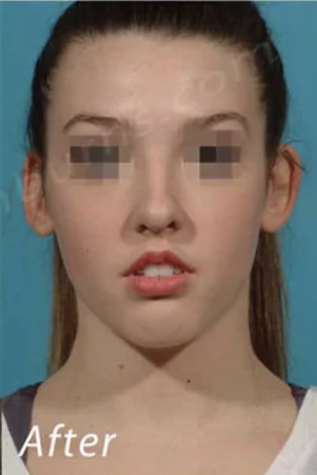 Rhinoplasty After, Female 24 - 3553