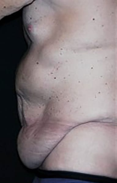 Penis Enhancement Solutions Before, Male 55 - 3564