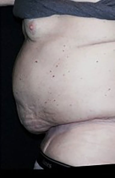 Penis Enhancement Solutions After, Male 55 - 3564