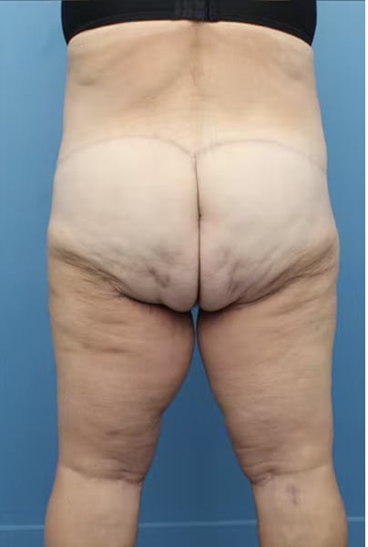Thigh Lift After, Female 46 - 3560