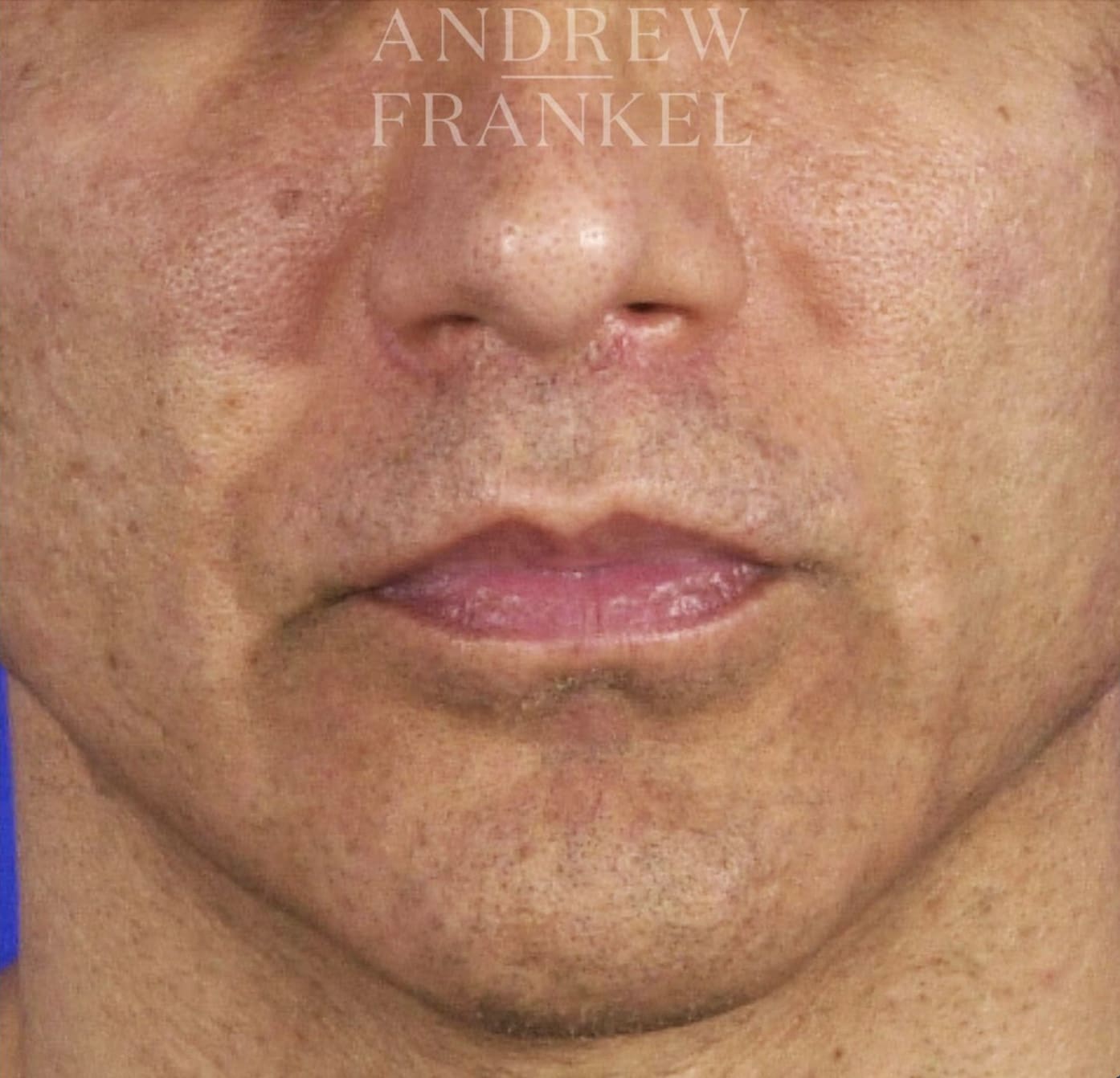 Lip Lift After, Male 49 - 3565