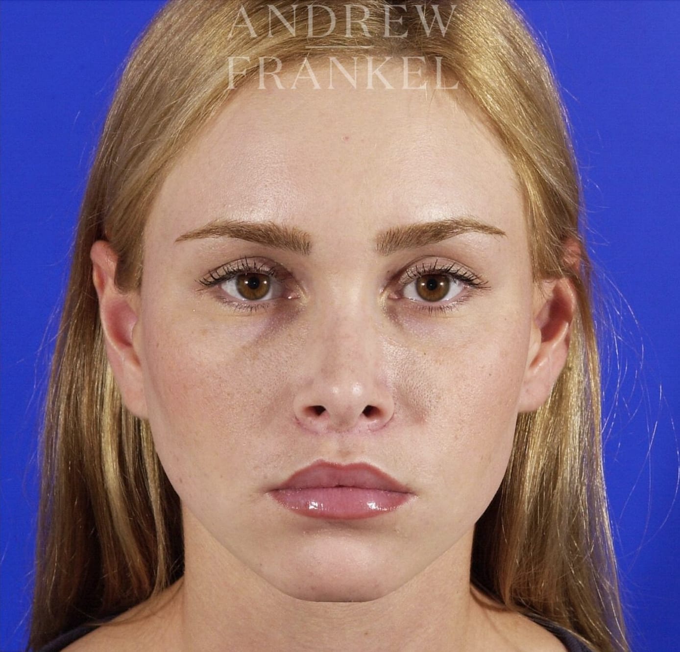 Lip Lift After, Female 24 - 310