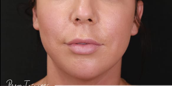 Lip Lift Before, Female 38 - 3567