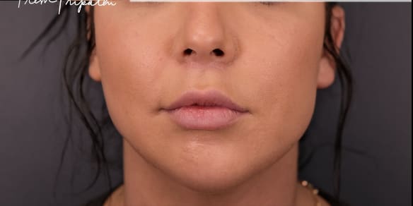 Lip Lift After, Female 38 - 3567