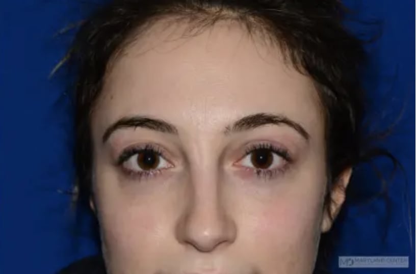 Blepharoplasty After, Female 34 - 3607