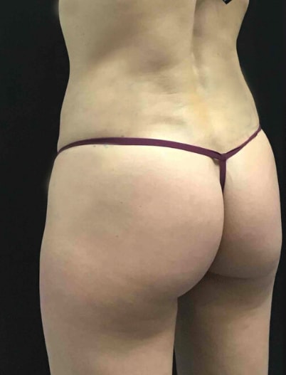 Brazilian Butt Lift Before, Female 35 - 3633