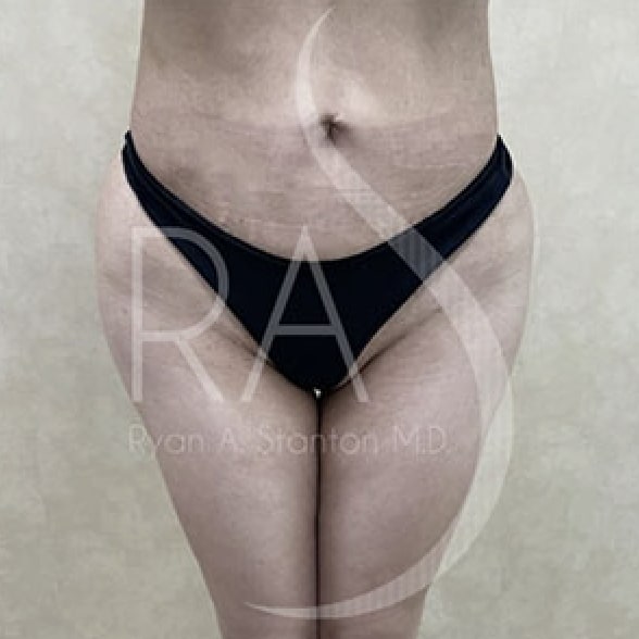 Butt Augmentation After, Female 31 - 3639