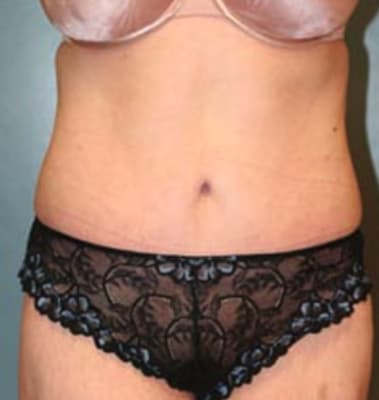 Tummy Tuck (Abdominoplasty) After, Female 35 - 3645