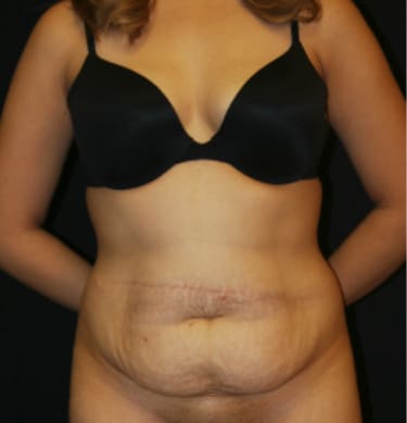 Tummy Tuck (Abdominoplasty) Before, Female 30 - 3646