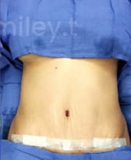 Tummy Tuck (Abdominoplasty) After, Female 38 - 3648