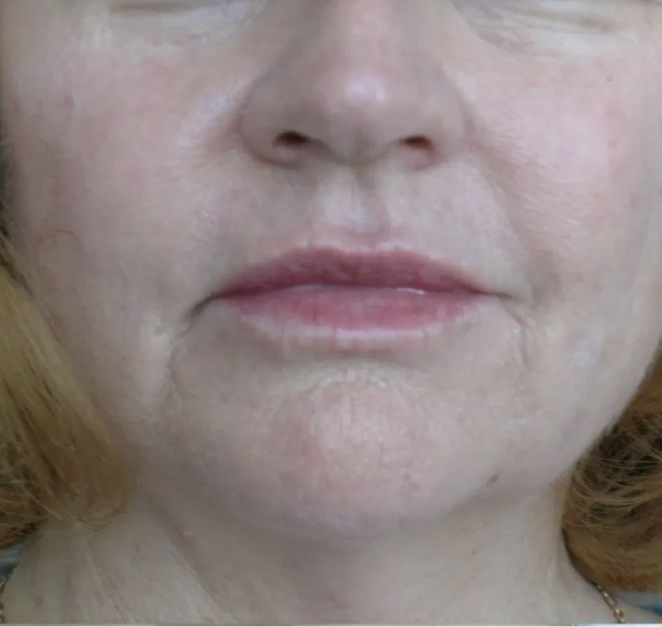 Dermal Fillers & Injectables After, Female 56 - 3665