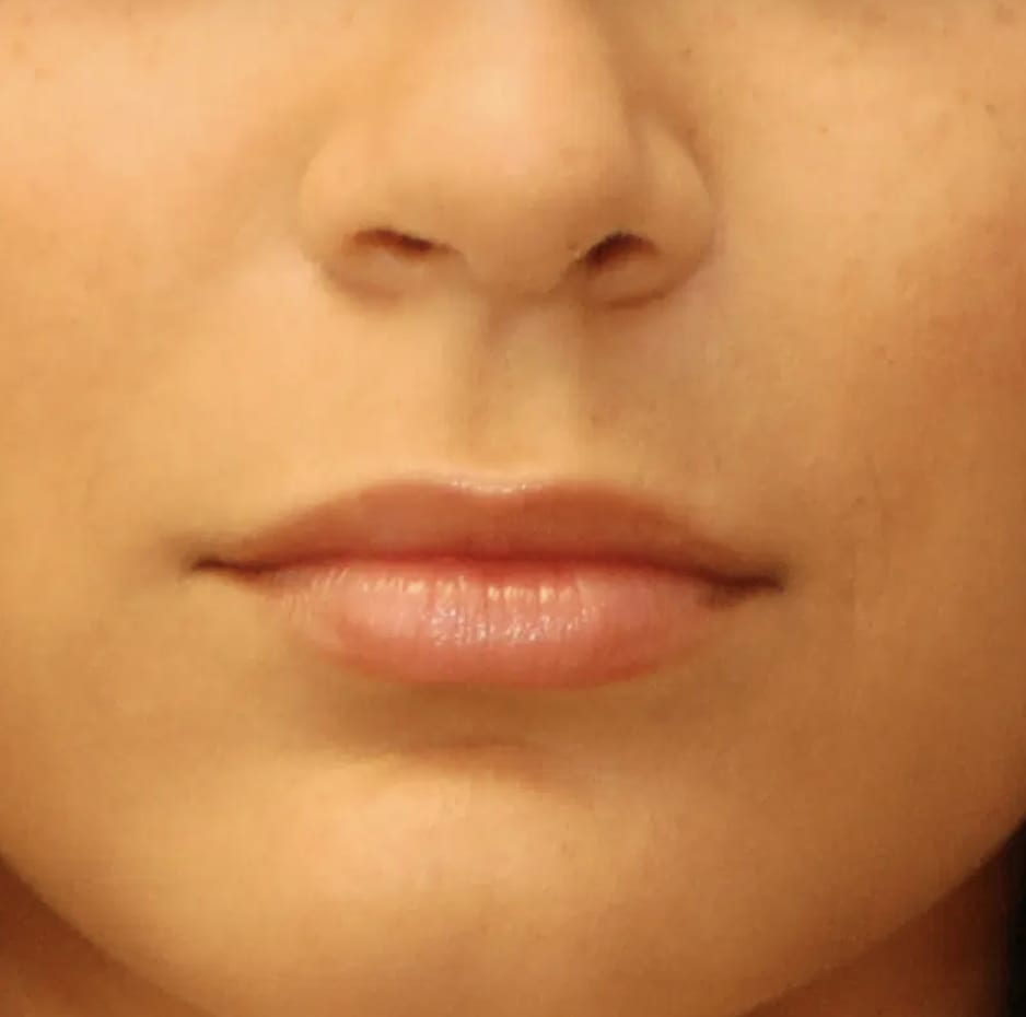 Dermal Fillers & Injectables After, Female 28 - 3666