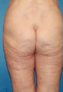 Thigh Lift Before, Female 56 - 3694