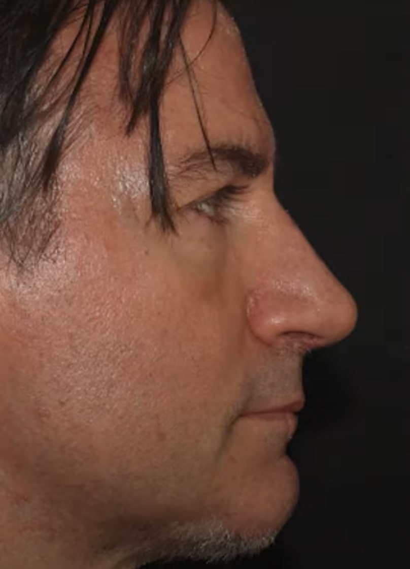 Chin Augmentation After, Male 53 - 3695