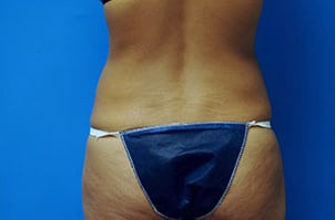 Liposuction After, Female 27 - 3697