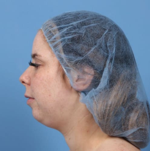 Chin Augmentation Before, Female 28 - 3700