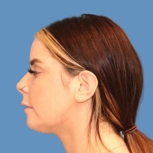 Chin Augmentation After, Female 28 - 3700