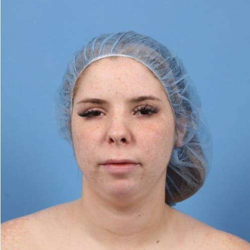 Chin Augmentation Before, Female 28 - 3701
