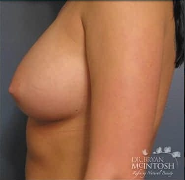 Breast Augmentation (Augmentation Mammaplasty) After, Female 36 - 3706