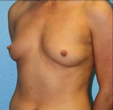 Breast Augmentation (Augmentation Mammaplasty) Before, Female 27 - 3709