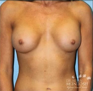 Breast Augmentation (Augmentation Mammaplasty) After, Female 27 - 3710