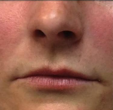 Lip Augmentation Solutions Before, Female 27 - 3715