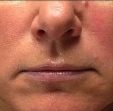 Lip Augmentation Solutions Before, Female 45 - 3716