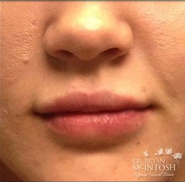 Lip Augmentation Solutions After, Female 39 - 3717