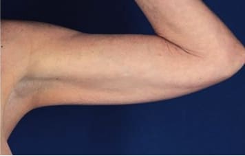 Arm Lift Before, Female 53 - 3724