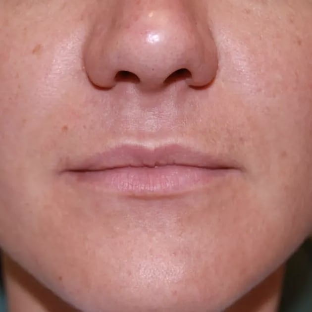 Lip Augmentation and Injections Before, Female 34 - 3729