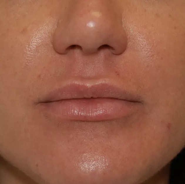 Lip Augmentation and Injections After, Female 34 - 3729