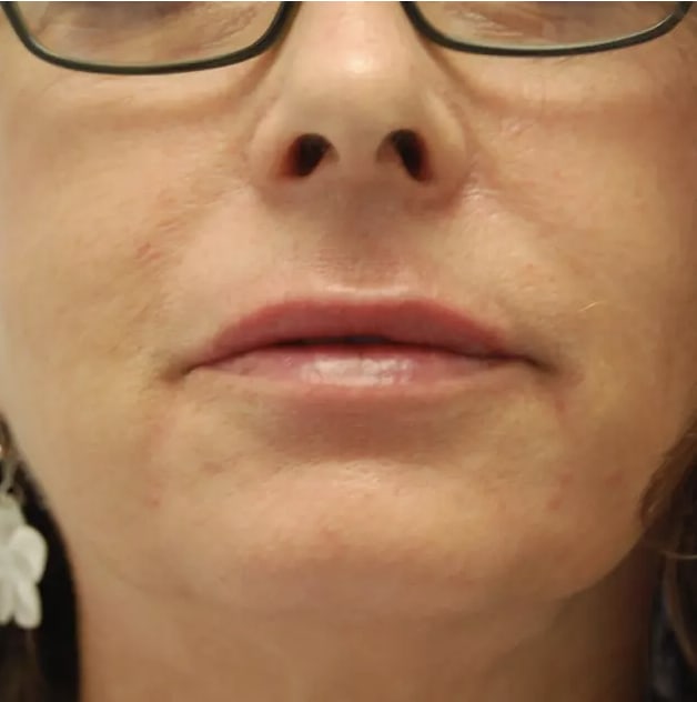 Lip Augmentation and Injections After, Female 48 - 3730