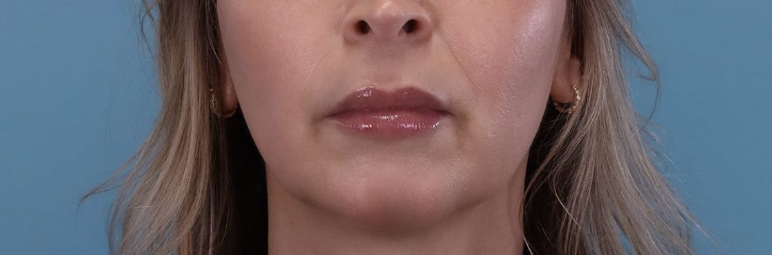 Lip Augmentation and Injections After, Female 52 - 3731