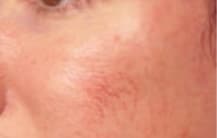 Vein Treatment Before, Female 38 - 3735