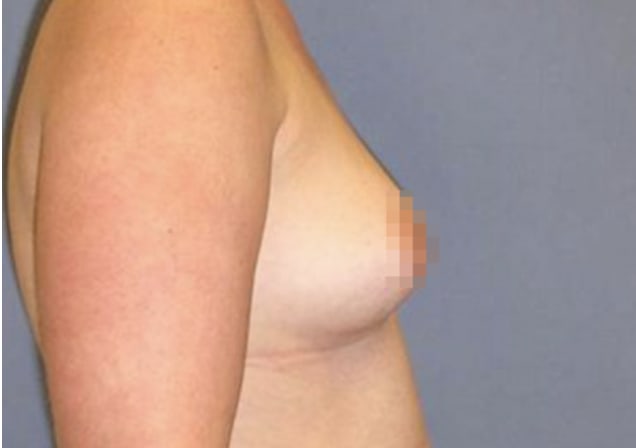 Breast Augmentation (Augmentation Mammaplasty) Before, Female 35 - 3739