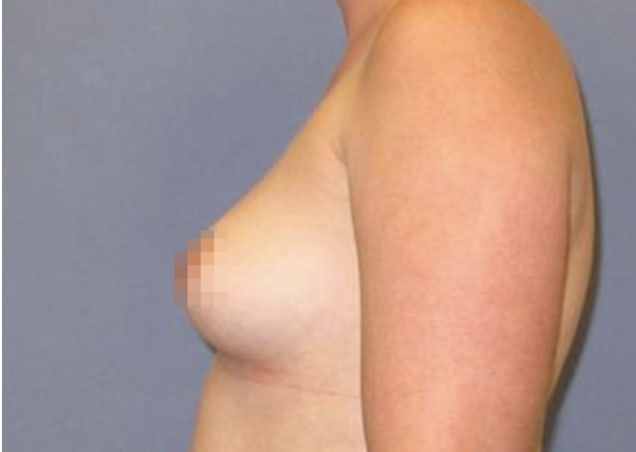 Breast Augmentation (Augmentation Mammaplasty) Before, Female 35 - 3738