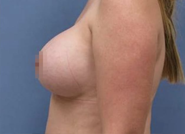 Breast Augmentation (Augmentation Mammaplasty) After, Female 35 - 3738