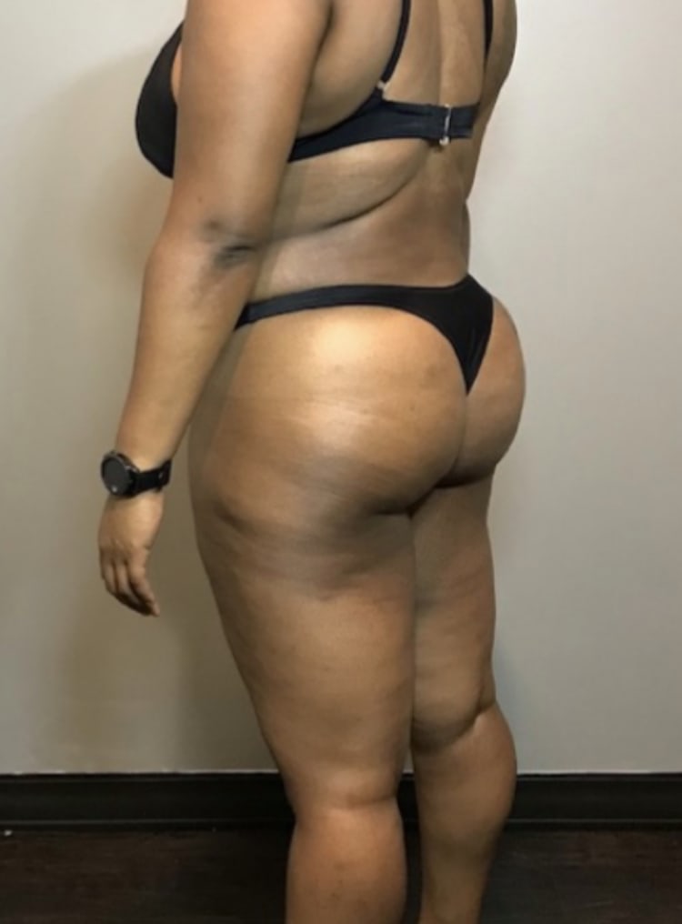 Brazilian Butt Lift After, Female 41 - 3750