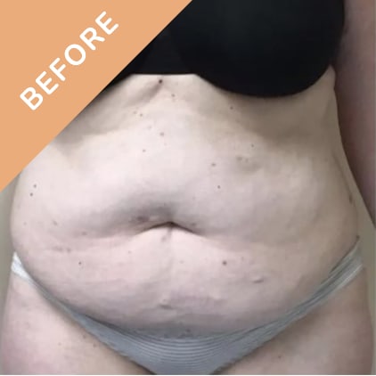 Abdominoplasty Before, Female 49 - 3803