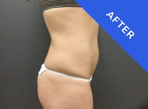 Liposuction After, Female 32 - 3806