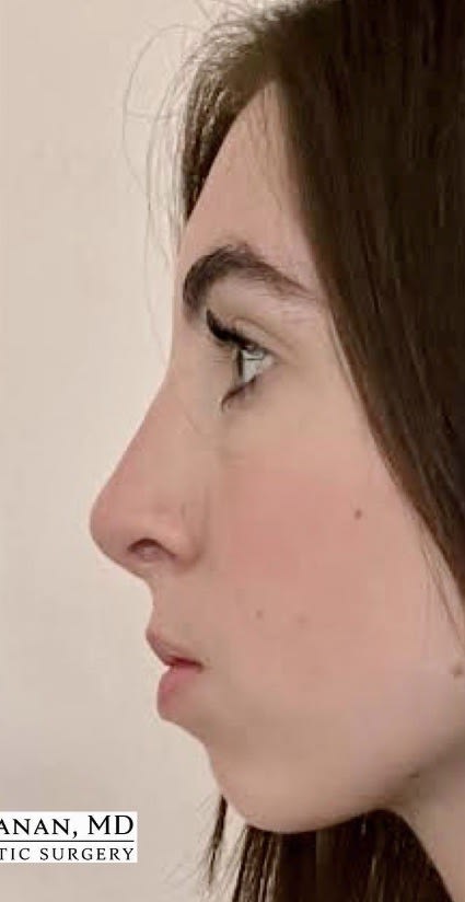 Rhinoplasty After, Female 19 - 3813