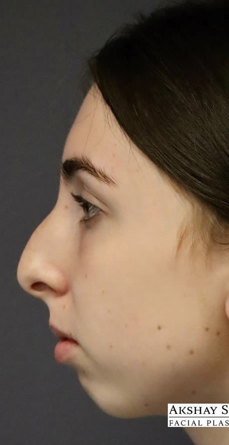 Rhinoplasty Before, Female 19 - 3813