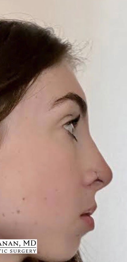Rhinoplasty After, Female 19 - 3814