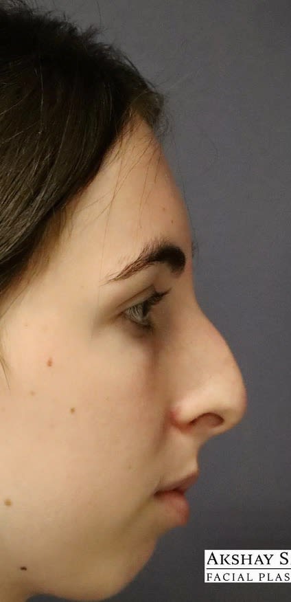 Rhinoplasty Before, Female 19 - 3814